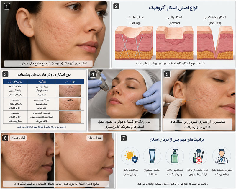 ارزیابی تخصصی انواع اسکار آکنه و انتخاب روش درمان مناسب برای جای جوش