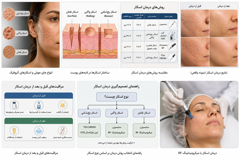 مکانیسم ایجاد اسکار آکنه و تفاوت اسکار یخشکنی، واگنی و غلتان در پوست