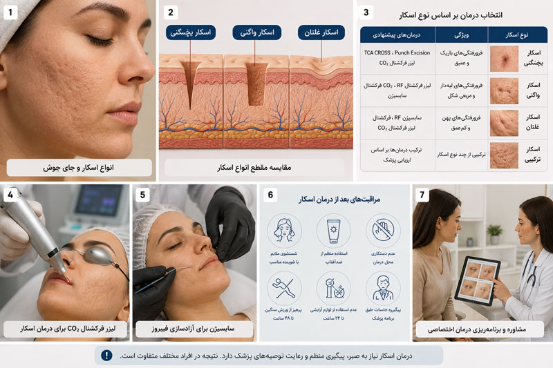 نقشه انتخاب برنامه درمان اسکار آکنه بر اساس نوع اسکار و روشهای سابسیژن، TCA CROSS، لیزر CO2 و RF