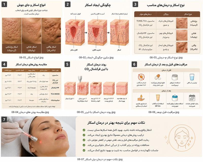 راهنمای انتخاب درمان جای جوش بر اساس نوع اسکار یخشکنی، واگنی و غلتان