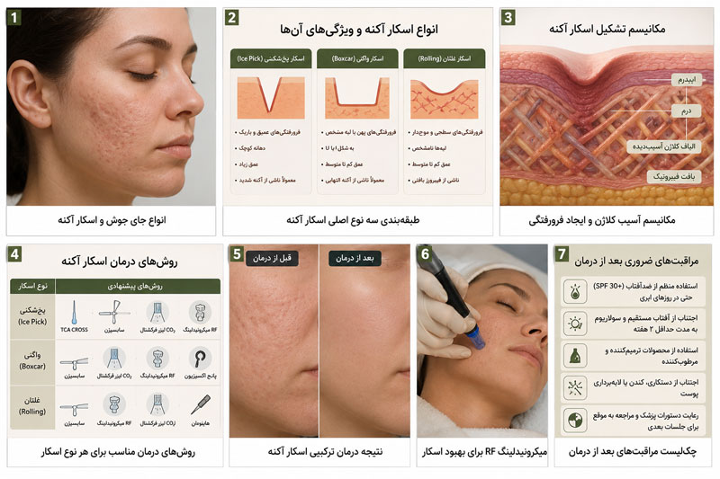 روشهای درمان اسکار آکنه شامل سابسیژن، TCA CROSS، لیزر CO2 و RF میکرونیدلینگ