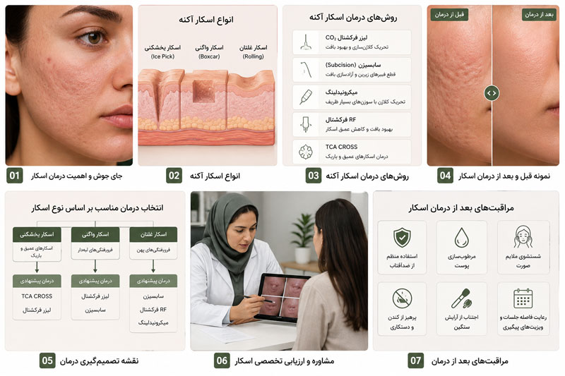 طراحی برنامه درمان اسکار آکنه بر اساس نوع غالب اسکار و روشهای ترکیبی