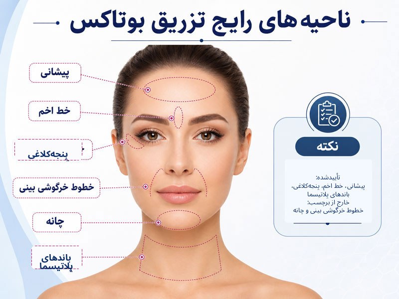 ناحیههای رایج تزریق بوتاکس در پیشانی، خط اخم، پنجهکلاغی، بینی، چانه و باندهای پلاتیسما