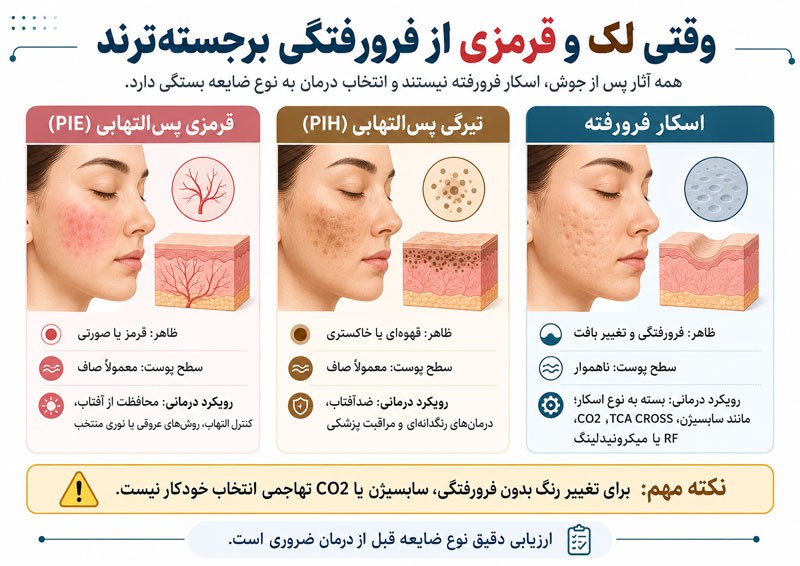 مقایسه قرمزی پسالتهابی PIE، تیرگی پسالتهابی PIH و اسکار فرورفته پس از آکنه و تفاوت رویکرد درمان هرکدام