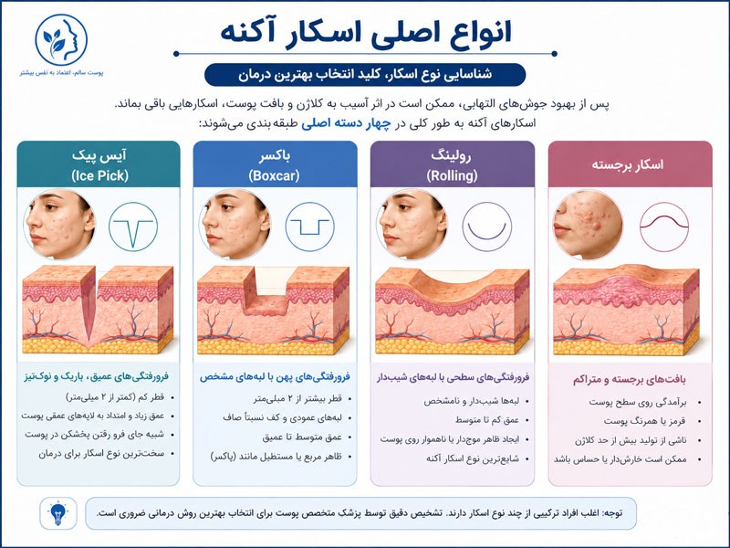انواع اصلی اسکار آکنه شامل آیس پیک، باکسر، رولینگ و اسکار برجسته